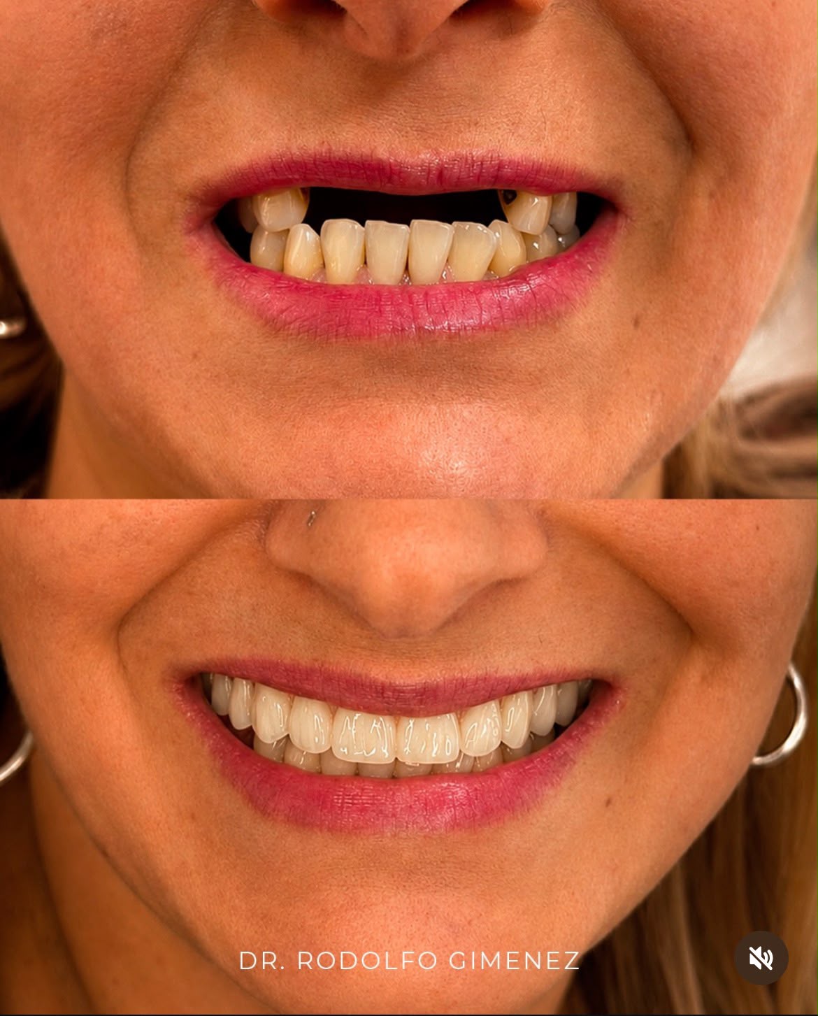 Caso 2: antes e depois de protocolo superior
