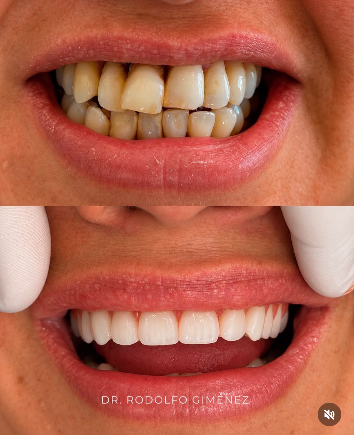 Caso 3: antes e depois de protocolo superior