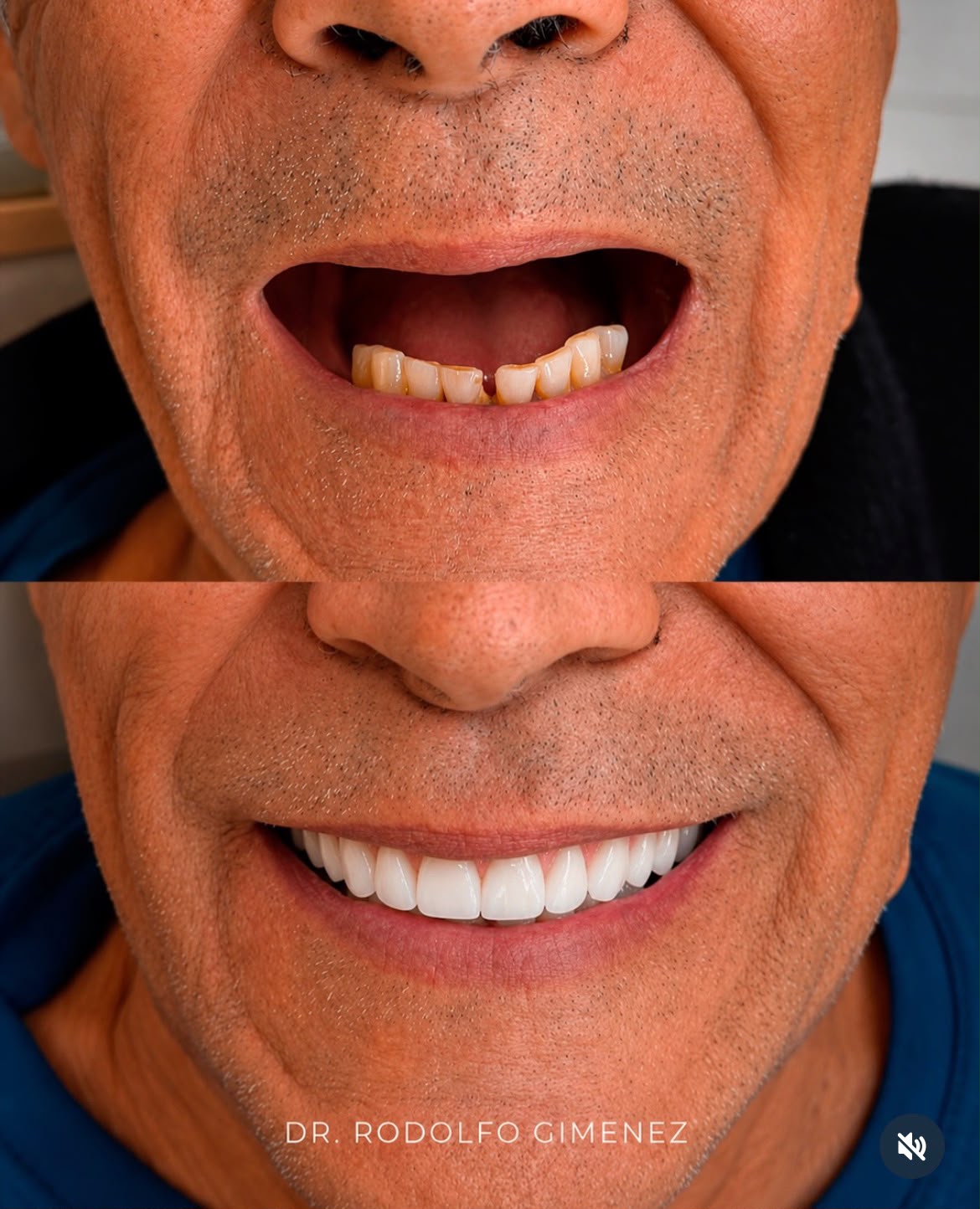Caso 4: antes e depois de protocolo superior